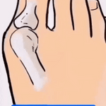 Corrector de Juanetes Ajustable Bunion Fix Pro